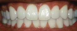 Teeth Whitening